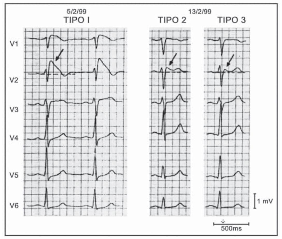 Gráfico de eletrocardiograma mostrando elevação do segmento ST em um paciente com síndrome de Brugada.