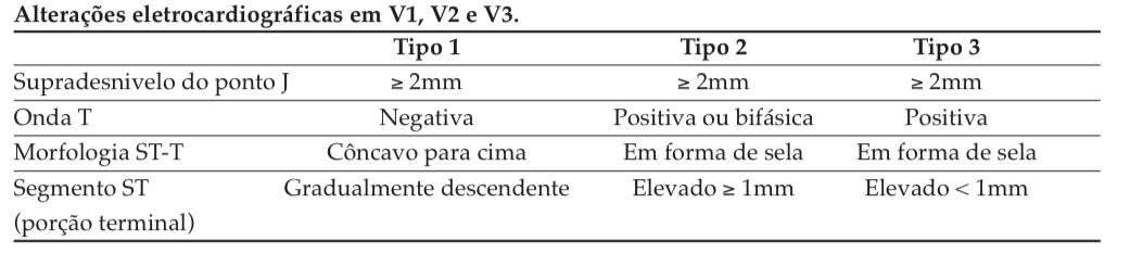 Gráfico de eletrocardiograma mostrando elevação do segmento ST em um paciente com síndrome de Brugada.